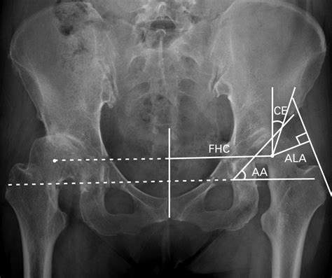 femoral anteversion pdf